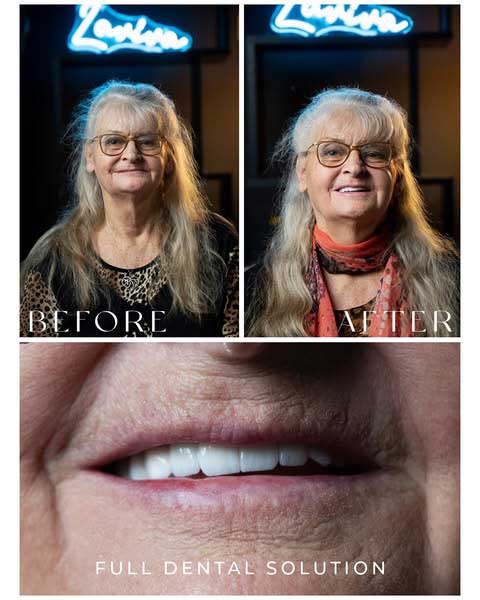 Before and After Dental Implants at Laviva Clinic