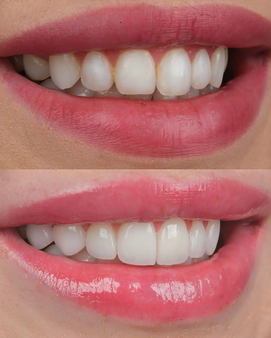 Before and after result, patient photo 4