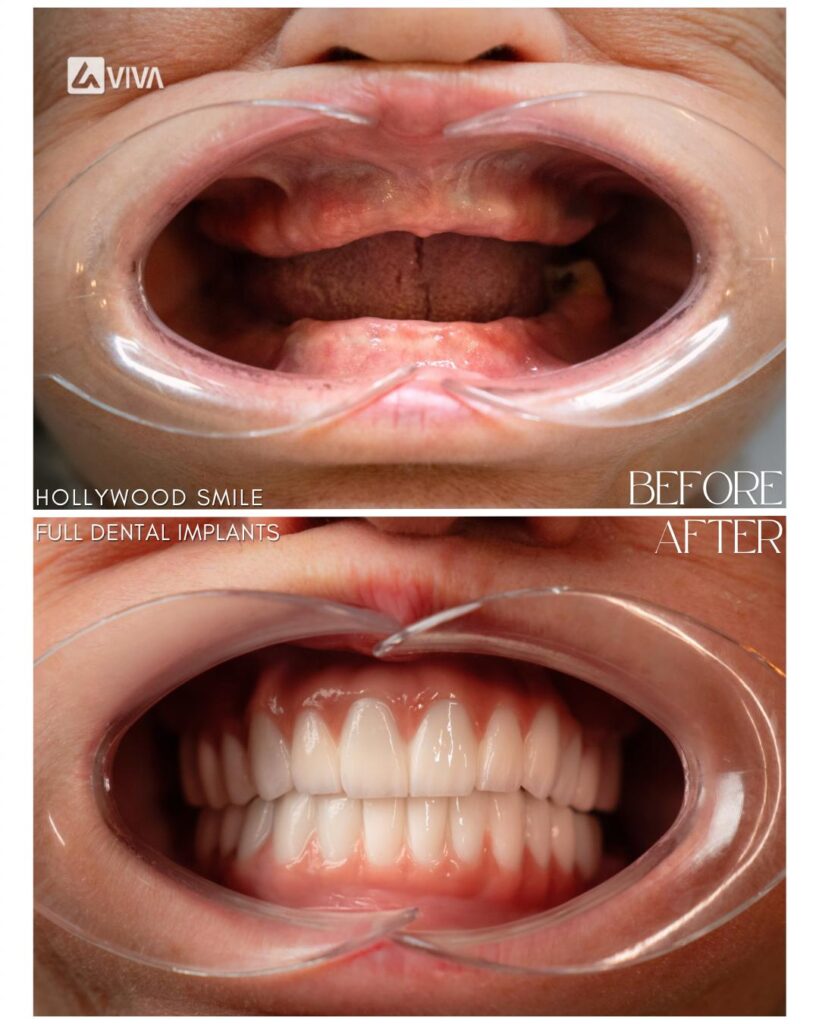 Instructions After Placing Crowns on Dental Implants