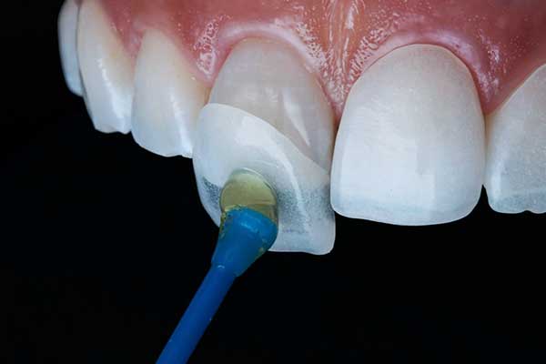 Best Veneers in Turkey