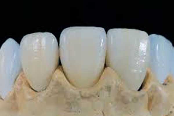 Best Veneers in Turkey